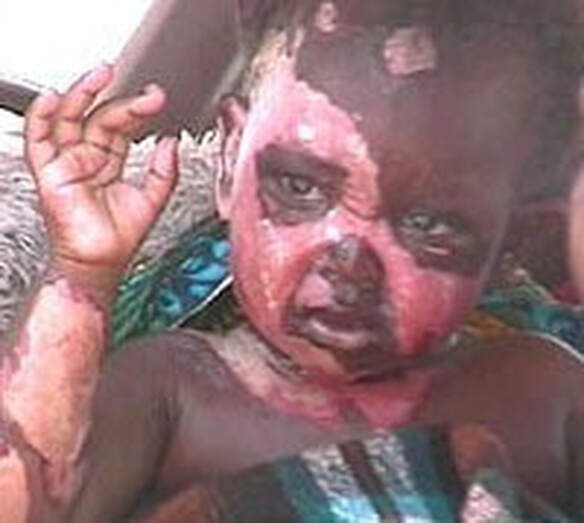 Juliet, aged two, during her recovery in Lusaka in 1999
